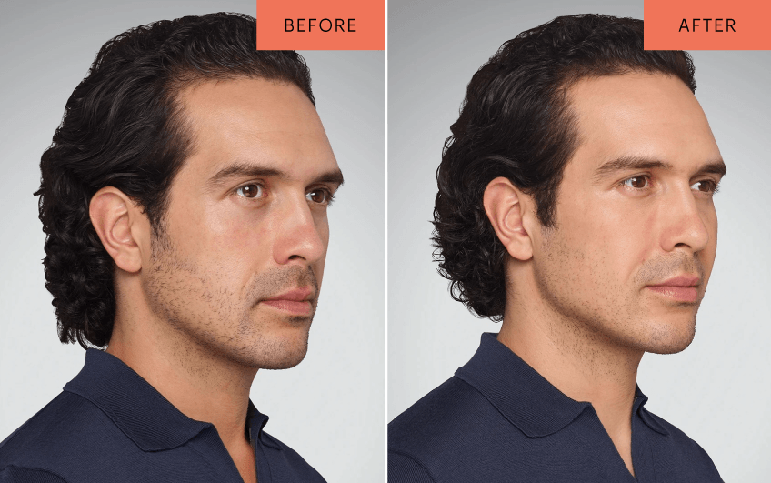 Pipeline Medical Juvederm Landing Page Before After DEVIN 35