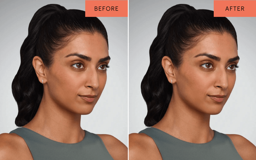 Pipeline Medical Juvederm Landing Page Before After JASKIRAN 28